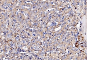 IHC staining of FFPE human thyroid cancer tissue with NDUFAF1 antibody. HIER: boil tissue sections in pH8 EDTA for 20 min and allow to cool before testing.