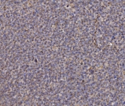 IHC staining of FFPE human lymphoma tissue with NDUFAF1 antibody. HIER: boil tissue sections in pH8 EDTA for 20 min and allow to cool before testing.