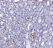 IHC staining of FFPE human Hashimoto's thyroiditis tissue with Endophilin A1 antibody. HIER: boil tissue sections in pH8 EDTA for 20 min and allow to cool before testing.