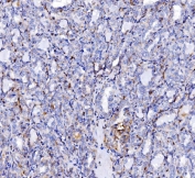 IHC staining of FFPE human Hashimoto's thyroiditis tissue with Endophilin A1 antibody. HIER: boil tissue sections in pH8 EDTA for 20 min and allow to cool before testing.