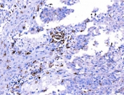 IHC staining of FFPE human laryngeal squamous cell carcinoma tissue with Endophilin A1 antibody. HIER: boil tissue sections in pH8 EDTA for 20 min and allow to cool before testing.