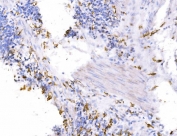 IHC staining of FFPE human gastric cancer tissue with Endophilin A1 antibody. HIER: boil tissue sections in pH8 EDTA for 20 min and allow to cool before testing.