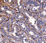 IHC staining of FFPE human Hashimoto's thyroiditis tissue with NEAS antibody. HIER: boil tissue sections in pH8 EDTA for 20 min and allow to cool before testing.