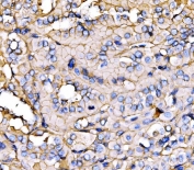 IHC staining of FFPE human thyroid papillary carcinoma tissue with NEAS antibody. HIER: boil tissue sections in pH8 EDTA for 20 min and allow to cool before testing.