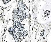 IHC staining of FFPE human breast cancer tissue with Splicing factor 1 antibody. HIER: boil tissue sections in pH8 EDTA for 20 min and allow to cool before testing.