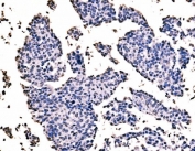 IHC staining of FFPE human bladder cancer tissue with Splicing factor 1 antibody. HIER: boil tissue sections in pH8 EDTA for 20 min and allow to cool before testing.