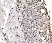 IHC staining of FFPE human liver cancer tissue with Splicing factor 1 antibody. HIER: boil tissue sections in pH8 EDTA for 20 min and allow to cool before testing.