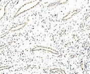 IHC staining of FFPE human squamous metaplasia of the renal pelvis tissue with Splicing factor 1 antibody. HIER: boil tissue sections in pH8 EDTA for 20 min and allow to cool before testing.