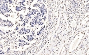 IHC staining of FFPE human bladder cancer tissue with SF1 antibody. HIER: boil tissue sections in pH8 EDTA for 20 min and allow to cool before testing.
