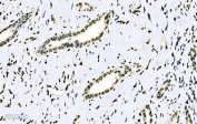 IHC staining of FFPE human squamous metaplasia of the renal pelvis tissue with SF1 antibody. HIER: boil tissue sections in pH8 EDTA for 20 min and allow to cool before testing.