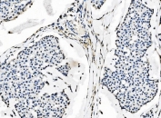 IHC staining of FFPE human breast cancer tissue with SF1 antibody. HIER: boil tissue sections in pH8 EDTA for 20 min and allow to cool before testing.