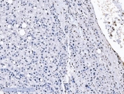 IHC staining of FFPE human liver cancer tissue with SF1 antibody. HIER: boil tissue sections in pH8 EDTA for 20 min and allow to cool before testing.