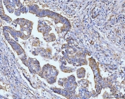 IHC staining of FFPE human gastric cancer tissue with HSPA9 antibody. HIER: boil tissue sections in pH8 EDTA for 20 min and allow to cool before testing.