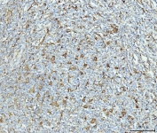 IHC staining of FFPE human lymphadenoma tissue with HSPA9 antibody. HIER: boil tissue sections in pH8 EDTA for 20 min and allow to cool before testing.