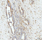 IHC staining of FFPE human appendiceal adenocarcinoma tissue with HSPA9 antibody. HIER: boil tissue sections in pH8 EDTA for 20 min and allow to cool before testing.