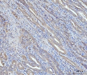 IHC staining of FFPE human gall bladder adenosquamous carcinoma tissue with HSPA9 antibody. HIER: boil tissue sections in pH8 EDTA for 20 min and allow to cool before testing.