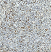 IHC staining of FFPE human lymphadenoma tissue with Aldehyde Dehydrogenase 1A1 antibody. HIER: boil tissue sections in pH8 EDTA for 20 min and allow to cool before testing.