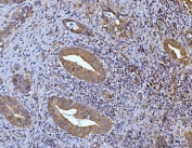IHC staining of FFPE human gall bladder adenosquamous carcinoma tissue with Glutaminase antibody. HIER: boil tissue sections in pH8 EDTA for 20 min and allow to cool before testing.