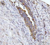 IHC staining of FFPE human appendiceal adenocarcinoma tissue with Glutaminase antibody. HIER: boil tissue sections in pH8 EDTA for 20 min and allow to cool before testing.