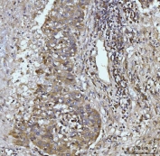IHC staining of FFPE human liver cancer tissue with Glutaminase antibody. HIER: boil tissue sections in pH8 EDTA for 20 min and allow to cool before testing.