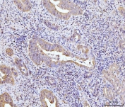 IHC staining of FFPE human gall bladder adenosquamous carcinoma tissue with GLS antibody. HIER: boil tissue sections in pH8 EDTA for 20 min and allow to cool before testing.