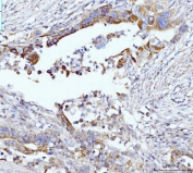 IHC staining of FFPE human appendiceal adenocarcinoma tissue with GLS antibody. HIER: boil tissue sections in pH8 EDTA for 20 min and allow to cool before testing.