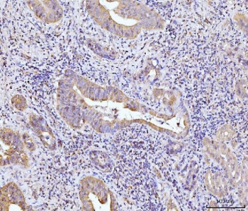 IHC staining of FFPE human gall bladder adenosquamous carcinoma tissue with GLS antibody. HIER: boil tissue sections in pH8 EDTA for 20 min and allow to cool before testing.