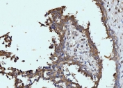 IHC staining of FFPE human breast cancer tissue with GLS antibody. HIER: boil tissue sections in pH8 EDTA for 20 min and allow to cool before testing.