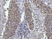 IHC staining of FFPE human liver cancer tissue with GLS antibody. HIER: boil tissue sections in pH8 EDTA for 20 min and allow to cool before testing.