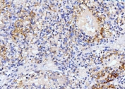 IHC staining of FFPE human renal carcinoma tissue with Dihydroorotate dehydrogenase antibody. HIER: boil tissue sections in pH8 EDTA for 20 min and allow to cool before testing.