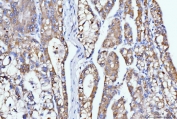 IHC staining of FFPE human liver cancer tissue with Dihydroorotate dehydrogenase antibody. HIER: boil tissue sections in pH8 EDTA for 20 min and allow to cool before testing.