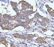 IHC staining of FFPE human breast cancer tissue with Dihydroorotate dehydrogenase antibody. HIER: boil tissue sections in pH8 EDTA for 20 min and allow to cool before testing.
