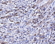 IHC staining of FFPE human gastric cancer tissue with Dihydroorotate dehydrogenase antibody. HIER: boil tissue sections in pH8 EDTA for 20 min and allow to cool before testing.