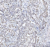 IHC staining of FFPE human metaplasia of squamous cells of the renal pelvis tissue with MCM6 antibody. HIER: boil tissue sections in pH8 EDTA for 20 min and allow to cool before testing.