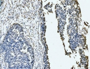 IHC staining of FFPE human bladder epithelial carcinoma tissue with MCM6 antibody. HIER: boil tissue sections in pH8 EDTA for 20 min and allow to cool before testing.