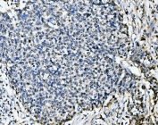 IHC staining of FFPE human lung cancer tissue with MCM6 antibody. HIER: boil tissue sections in pH8 EDTA for 20 min and allow to cool before testing.