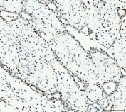 IHC staining of FFPE human breast cancer tissue with MCM6 antibody. HIER: boil tissue sections in pH8 EDTA for 20 min and allow to cool before testing.