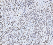 IHC staining of FFPE human metaplasia of squamous cells of the renal pelvis tissue with MCM6 antibody. HIER: boil tissue sections in pH8 EDTA for 20 min and allow to cool before testing.