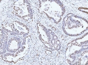 IHC staining of FFPE human rectal moderately differentiate adenocarcinoma tissue with MCM6 antibody. HIER: boil tissue sections in pH8 EDTA for 20 min and allow to cool before testing.