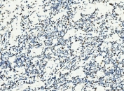 IHC staining of FFPE human Hodgkin's lymphoma tissue with MCM6 antibody. HIER: boil tissue sections in pH8 EDTA for 20 min and allow to cool before testing.