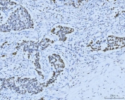 IHC staining of FFPE human lung cancer tissue with MCM6 antibody. HIER: boil tissue sections in pH8 EDTA for 20 min and allow to cool before testing.