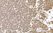 IHC staining of FFPE human liver cancer tissue with SND1 antibody. HIER: boil tissue sections in pH8 EDTA for 20 min and allow to cool before testing.