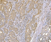 IHC staining of FFPE human metaplasia of squamous cells of the renal pelvis tissue with SND1 antibody. HIER: boil tissue sections in pH8 EDTA for 20 min and allow to cool before testing.