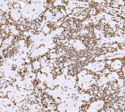 IHC staining of FFPE human Hodgkin's lymphoma tissue with SND1 antibody. HIER: boil tissue sections in pH8 EDTA for 20 min and allow to cool before testing.
