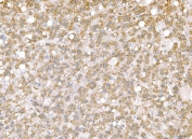 IHC staining of FFPE human liver cancer tissue with TDRD11 antibody. HIER: boil tissue sections in pH8 EDTA for 20 min and allow to cool before testing.