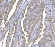 IHC staining of FFPE human rectum adenocarcinoma tissue with TDRD11 antibody. HIER: boil tissue sections in pH8 EDTA for 20 min and allow to cool before testing.