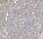 IHC staining of FFPE human metaplasia of squamous cells of the renal pelvis tissue with TDRD11 antibody. HIER: boil tissue sections in pH8 EDTA for 20 min and allow to cool before testing.