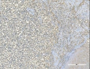 IHC staining of FFPE human testis cancer with EPRS1 antibody. HIER: boil tissue sections in pH8 EDTA for 20 min and allow to cool before testing.