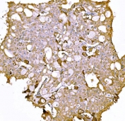 IHC staining of FFPE human liver cancer tissue with Prothrombin antibody. HIER: boil tissue sections in pH8 EDTA for 20 min and allow to cool before testing.