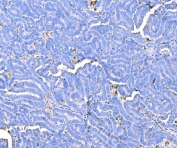 IHC staining of FFPE human ovarian cancer tissue with Prothrombin antibody. HIER: boil tissue sections in pH8 EDTA for 20 min and allow to cool before testing.